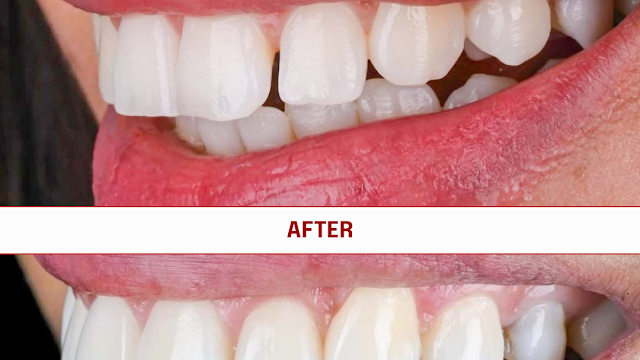 Veneers Dominican Republic